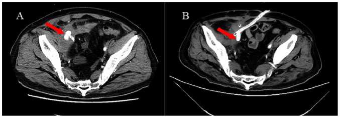 Delayed right external iliac artery disruption after radical cystectomy: A case report and literature review.