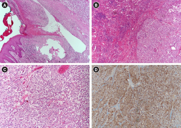 Bleeding metastasis of renal cell cancer to anal canal treated with radiation.