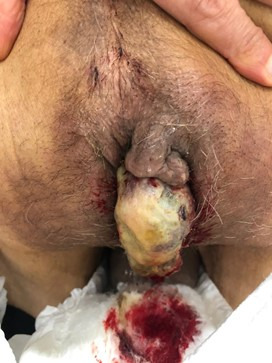 Bleeding metastasis of renal cell cancer to anal canal treated with radiation.