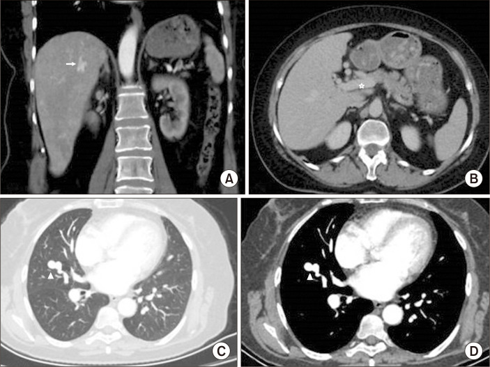 Endovascular Treatment of a Giant Aneurysm of the Aberrant Right Hepatic Artery in a Patient with Osler-Weber-Rendu Syndrome: A Case Report.