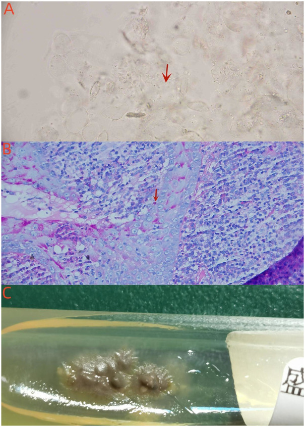 Cutaneous disseminated sporotrichosis associated with diabetes: A case report and literature review.