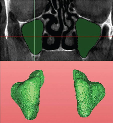 Evaluation of Maxillary Sinus Volume of Class III Individuals with Different Jaw Positions by Cone-Beam Computed Tomography.