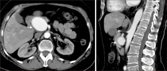 Endovascular Treatment of a Giant Aneurysm of the Aberrant Right Hepatic Artery in a Patient with Osler-Weber-Rendu Syndrome: A Case Report.