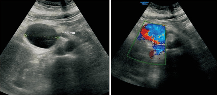 Endovascular Treatment of a Giant Aneurysm of the Aberrant Right Hepatic Artery in a Patient with Osler-Weber-Rendu Syndrome: A Case Report.