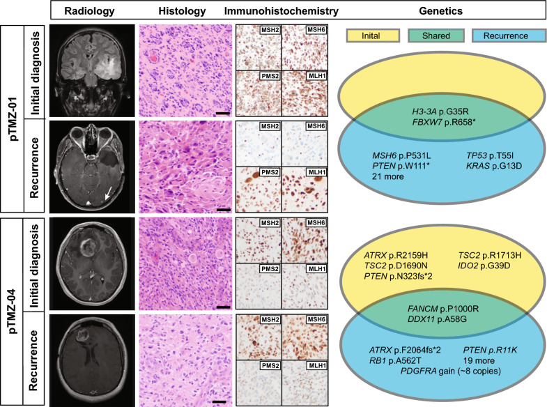 Molecular profiling of pre- and post-treatment pediatric high-grade astrocytomas reveals acquired increased tumor mutation burden in a subset of recurrences.