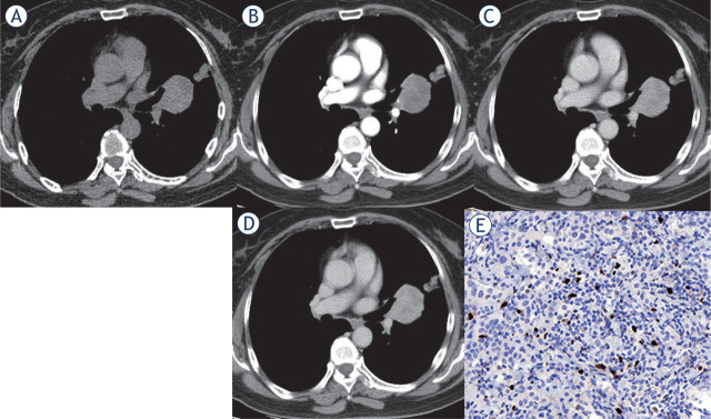 Central and peripheral pulmonary sclerosing pneumocytomas: multi-phase CT study and comparison with Ki-67.