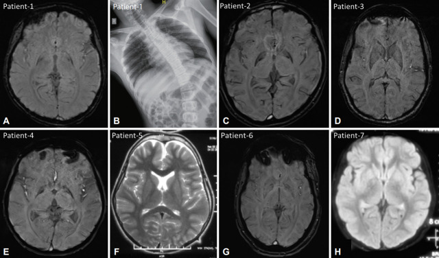 KMT2B-Related Dystonia in Indian Patients With Literature Review and Emphasis on Asian Cohort.