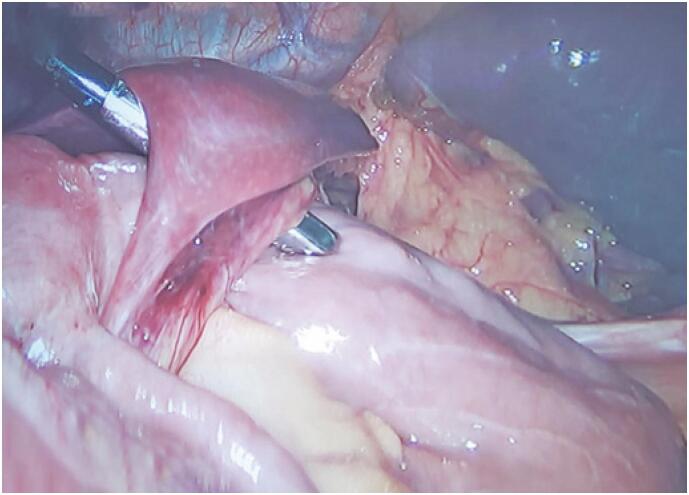 Internal post-bariatric hernia due to hepatic adhesion: a case report.