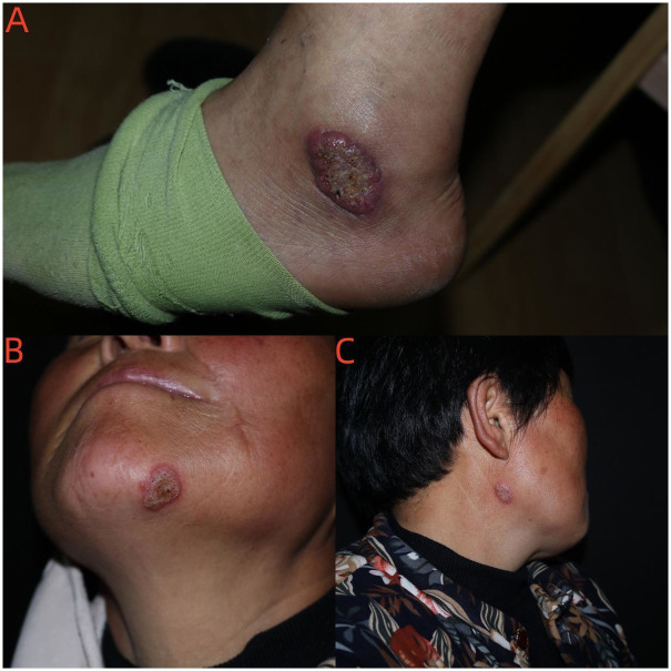 Cutaneous disseminated sporotrichosis associated with diabetes: A case report and literature review.