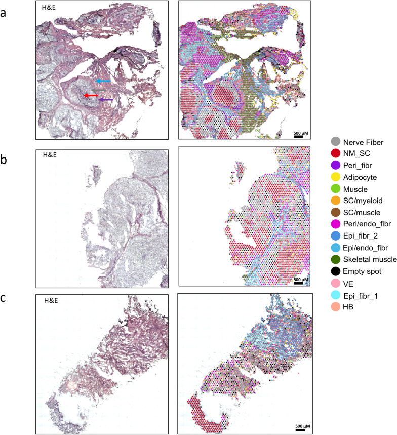 Integration of single-nuclei RNA-sequencing, spatial transcriptomics and histochemistry defines the complex microenvironment of NF1-associated plexiform neurofibromas.