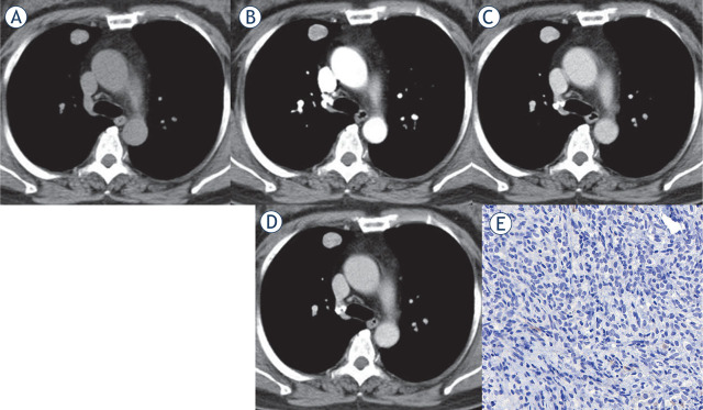 Central and peripheral pulmonary sclerosing pneumocytomas: multi-phase CT study and comparison with Ki-67.