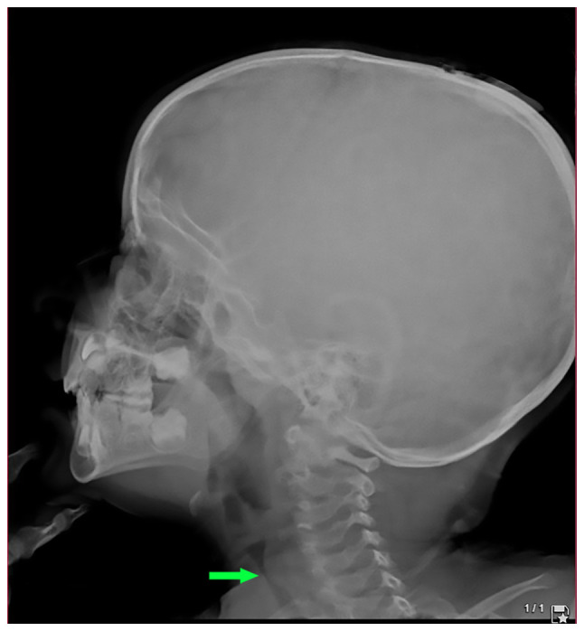 Challenges and successful management of subglottic tracheal stenosis in a 2‑year‑old child: A case report and a mini‑review of the literature.