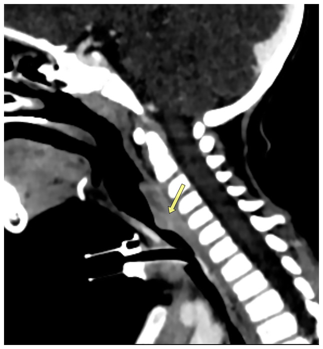 Challenges and successful management of subglottic tracheal stenosis in a 2‑year‑old child: A case report and a mini‑review of the literature.