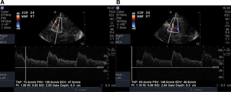 Transcranial Color-Coded Sonography With Angle Correction As a Screening Tool for Raised Intracranial Pressure.