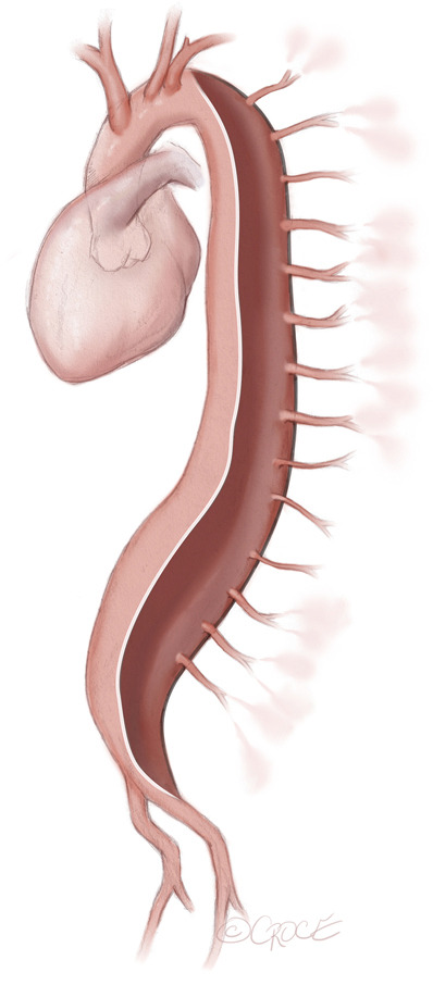 Minimally invasive staged segmental artery coil embolization (MIS<sup>2</sup>ACE) for spinal cord protection.