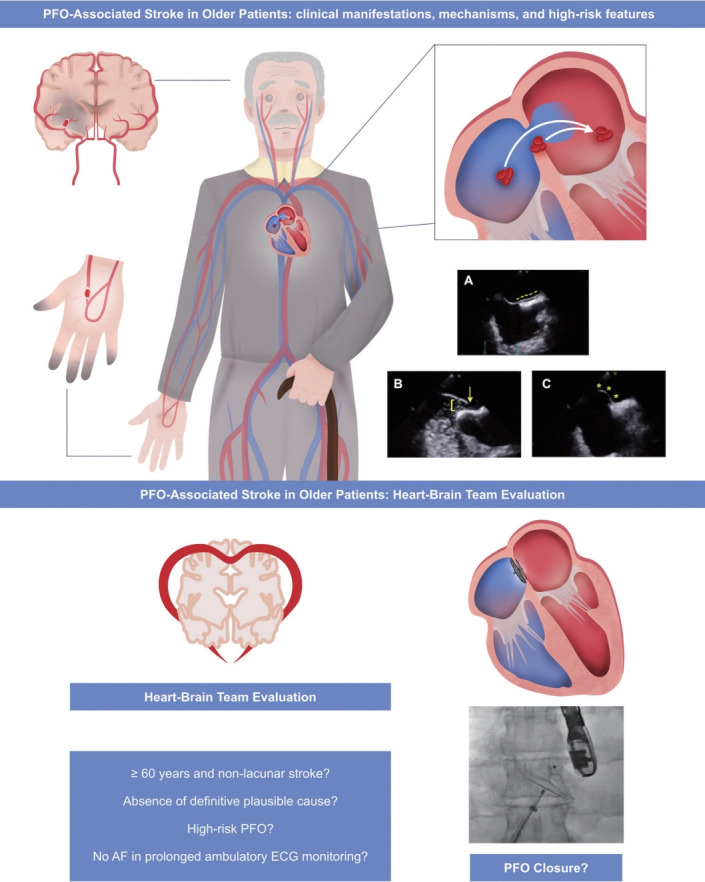 Cerebrovascular Events in Older Patients With Patent Foramen Ovale: Current Status and Future Perspectives.