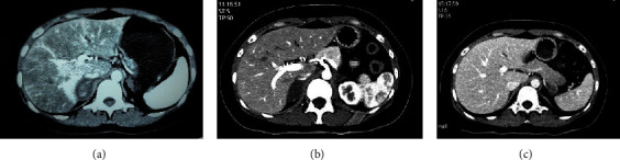 Adrenal Hemorrhage in Patients with Systemic Lupus Erythematosus and Antiphospholipid Syndrome: A Case Report and Literature Review.