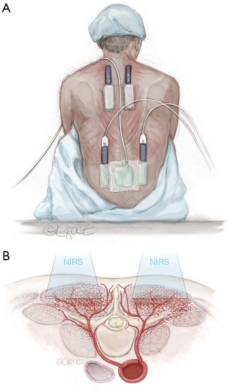 Minimally invasive staged segmental artery coil embolization (MIS<sup>2</sup>ACE) for spinal cord protection.