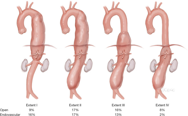 Minimally invasive staged segmental artery coil embolization (MIS<sup>2</sup>ACE) for spinal cord protection.