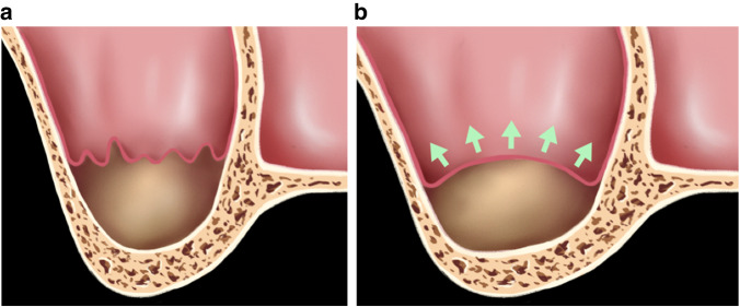 Maxillary sinus floor augmentation: a review of current evidence on anatomical factors and a decision tree.