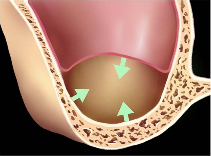 Maxillary sinus floor augmentation: a review of current evidence on anatomical factors and a decision tree.