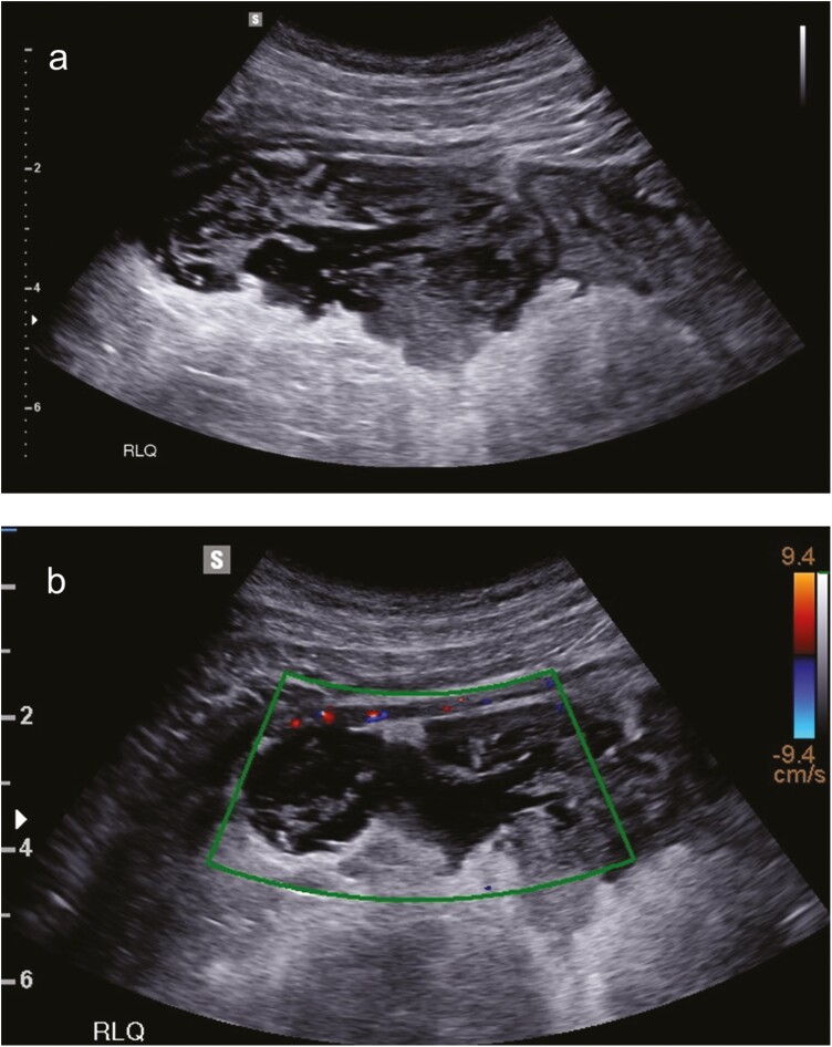 Bedside Intestinal Ultrasound Performed in an Inflammatory Bowel Disease Urgent Assessment Clinic Improves Clinical Decision-Making and Resource Utilization.