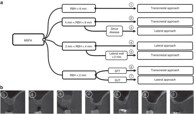 Maxillary sinus floor augmentation: a review of current evidence on anatomical factors and a decision tree.