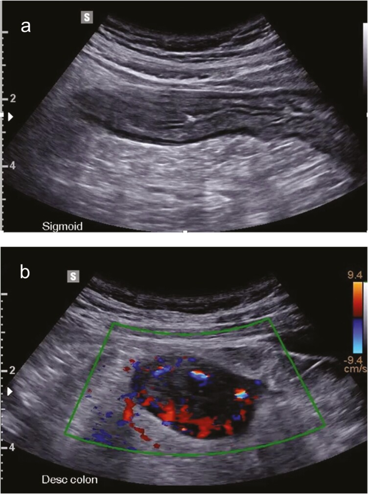 Bedside Intestinal Ultrasound Performed in an Inflammatory Bowel Disease Urgent Assessment Clinic Improves Clinical Decision-Making and Resource Utilization.