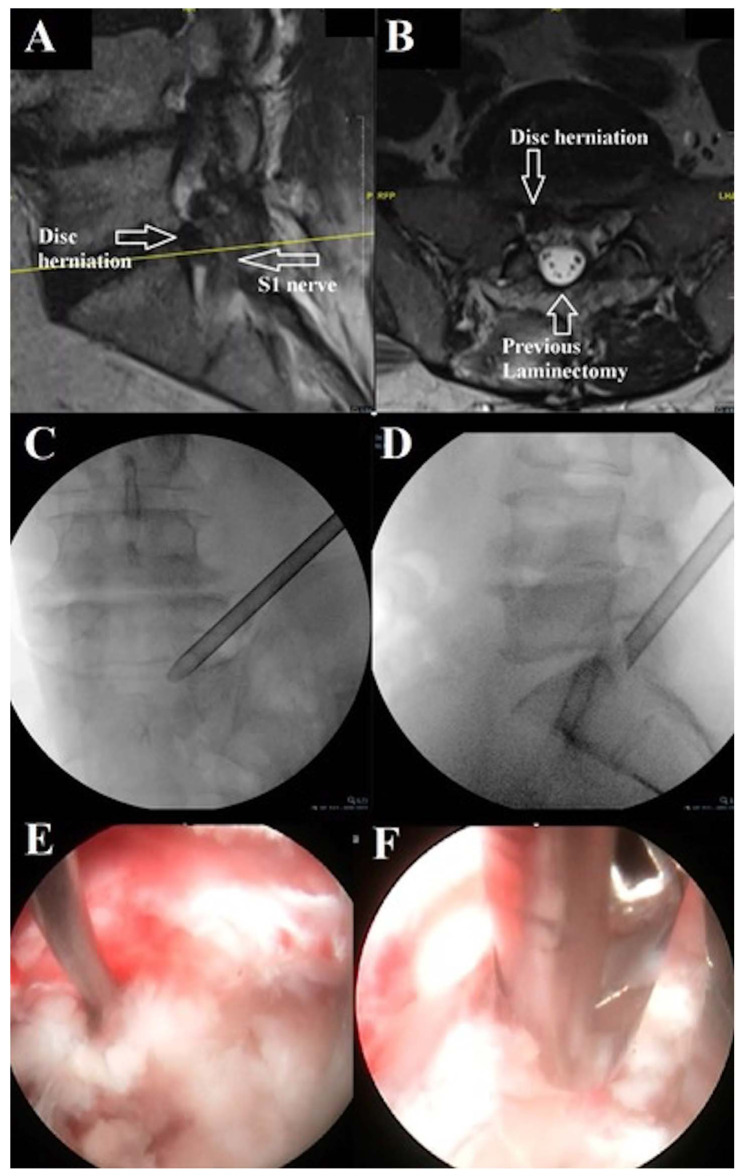 Development of an Endoscopic Spine Surgery Program: Overview and Basic Considerations for Implementation.