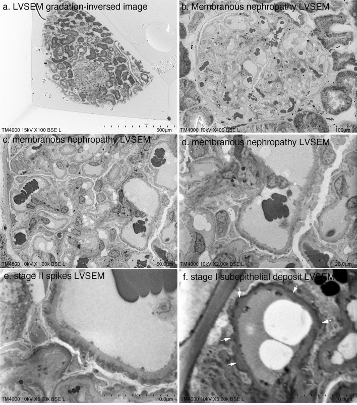 Direct observation of epoxy resin blocks for renal biopsy by low-vacuum scanning electron microscopy.