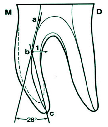 Comparison of Dentinal Defects Formation in Straight, Moderate and Severely Curved Canals by Three Distinctive Nickel Titanium Instruments: An <i>in vitro</i> Study.