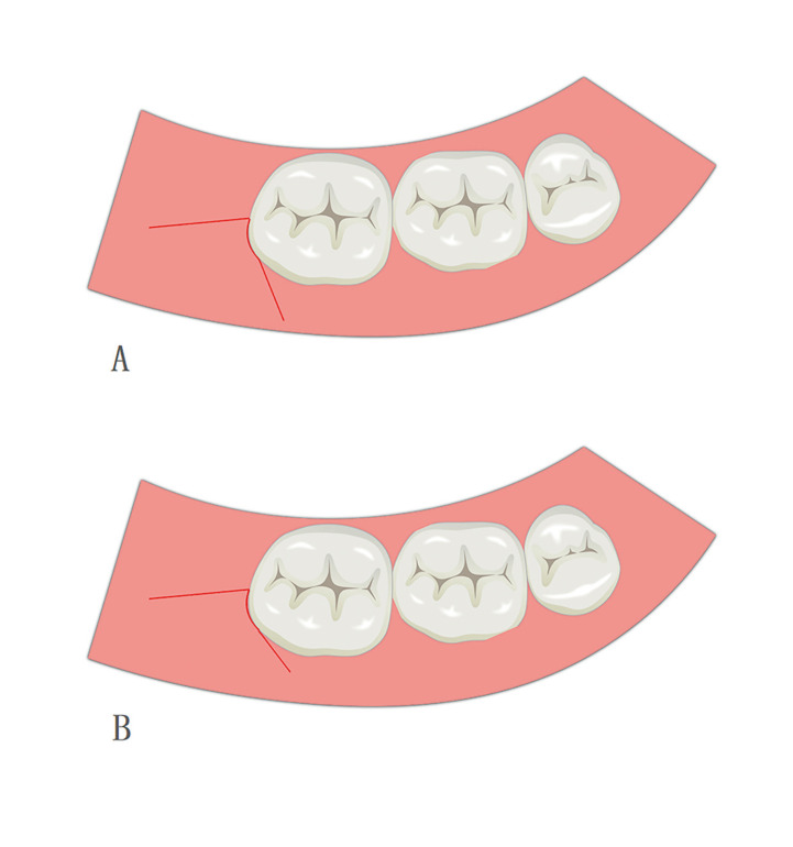 A modified triangular flap suture method used for inferior third molar extraction: A three-arm randomized clinical trial for the assessment of quality of life.