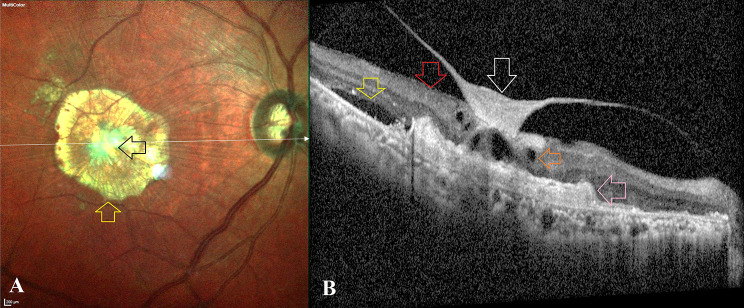 Central posterior hyaloid fibrosis: evolution and outcomes.