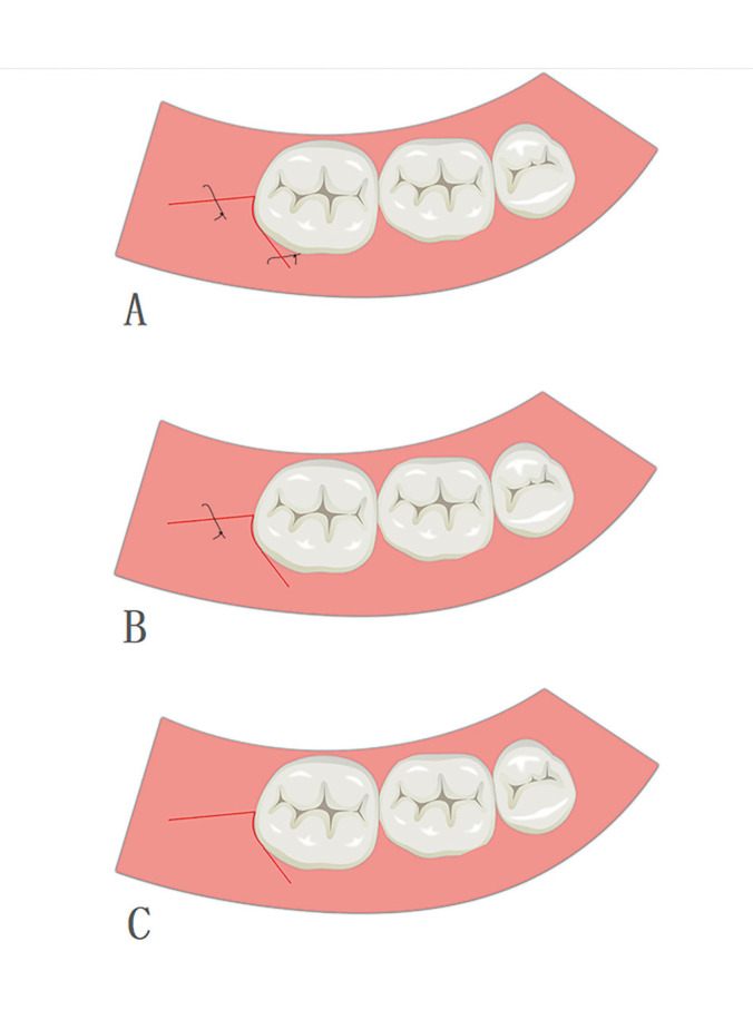 A modified triangular flap suture method used for inferior third molar extraction: A three-arm randomized clinical trial for the assessment of quality of life.