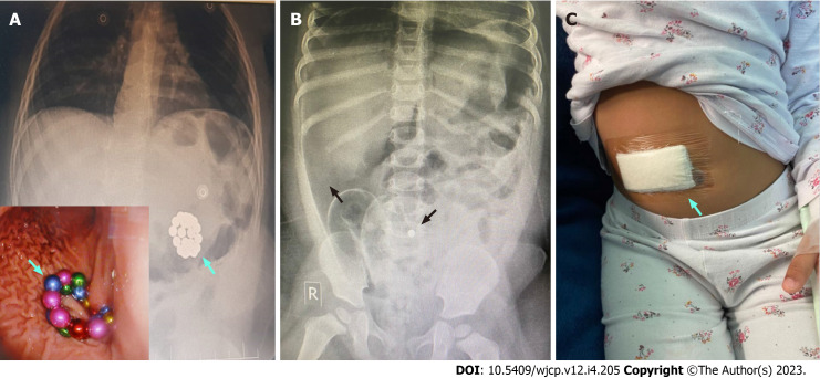 Accidental ingestion of foreign bodies/harmful materials in children from Bahrain: A retrospective cohort study.