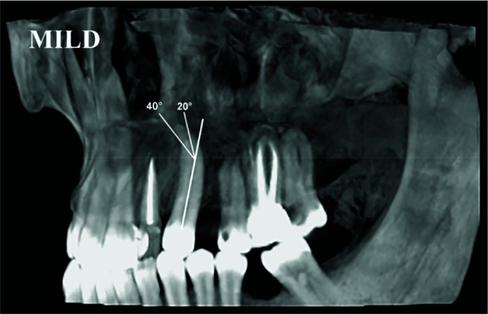 Evaluation of Root Dilaceration in Permanent Anterior and Canine Teeth in the Southern Subpopulation of Iran Using Cone-Beam Computed Tomography.