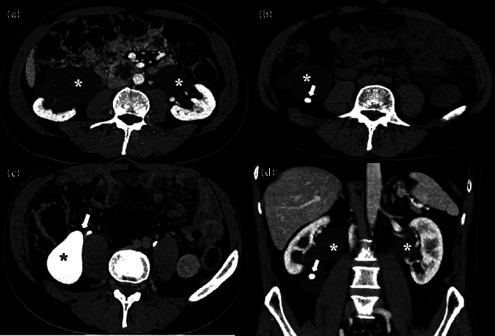 An Adult Case of Severe Asymptomatic Bilateral Ureteropelvic Junction Obstruction.