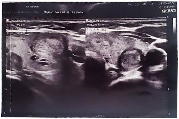 Tuberculous granulomatous inflammation of parathyroid adenoma manifested as primary hyperparathyroidism: A case report and a review of the literature.