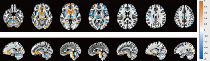 Is the Brainstem Activation Different Between Healthy Young Male and Female Volunteers at Initiation of Voiding? A High Definition 7-Tesla Magnetic Resonance Imaging Study.