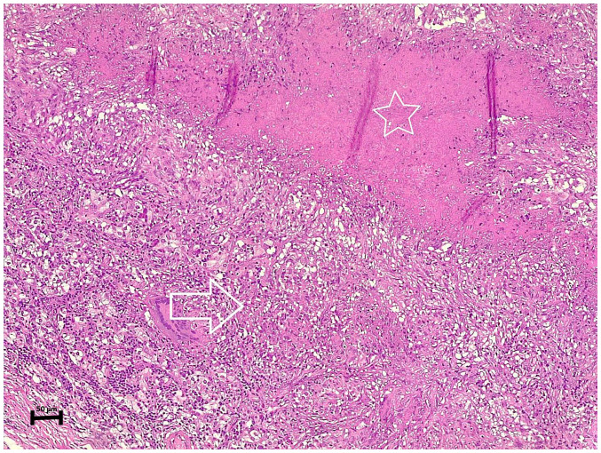 Tuberculous granulomatous inflammation of parathyroid adenoma manifested as primary hyperparathyroidism: A case report and a review of the literature.