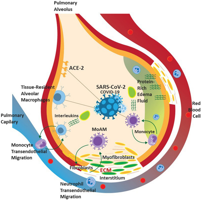 Post-COVID-19 Pulmonary Fibrosis: Facts-Challenges and Futures: A Narrative Review.