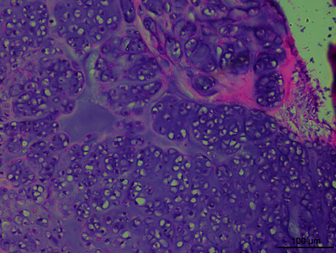 Next-Generation Sequencing Analysis of 3 Uterine Adenosarcomas with Heterogeneously Differentiated Genomic Mutations.