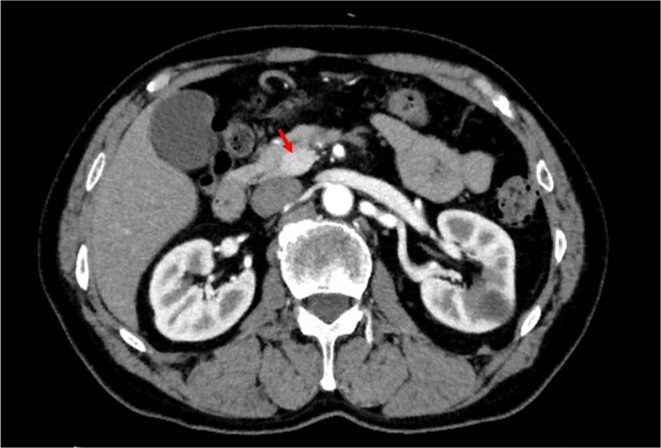 Continuous glucose monitoring in a patient with insulinoma presenting with unawareness of postprandial hypoglycemia.