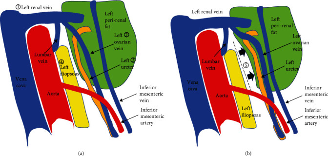 Ureter Injury in Laparoscopic Para-Aortic Lymphadenectomy for Endometrial Cancer by the Transperitoneal Approach.