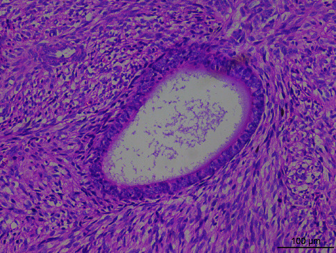 Next-Generation Sequencing Analysis of 3 Uterine Adenosarcomas with Heterogeneously Differentiated Genomic Mutations.