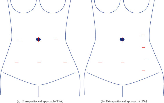 Ureter Injury in Laparoscopic Para-Aortic Lymphadenectomy for Endometrial Cancer by the Transperitoneal Approach.