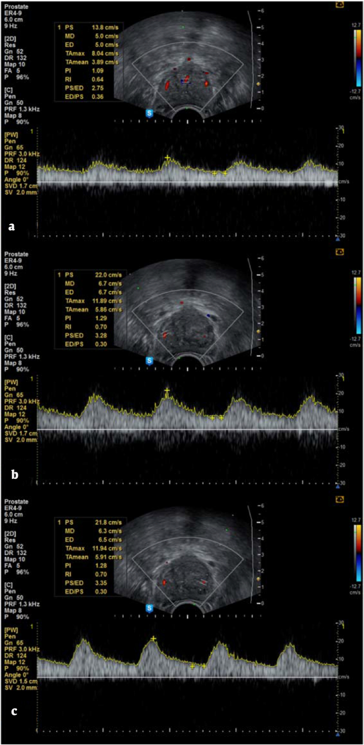 Changes of resistance indices after medication in benign prostatic hyperplasia: a prospective study