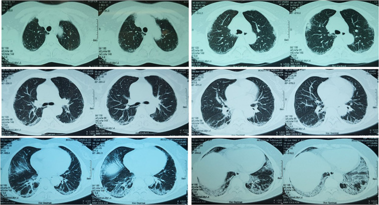 Post-COVID-19 Pulmonary Fibrosis: Facts-Challenges and Futures: A Narrative Review.