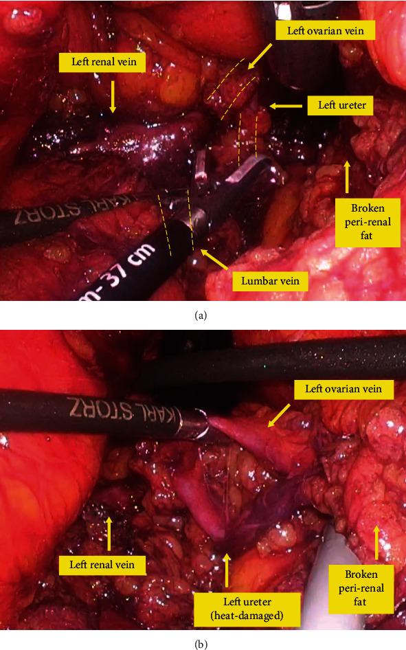 Ureter Injury in Laparoscopic Para-Aortic Lymphadenectomy for Endometrial Cancer by the Transperitoneal Approach.