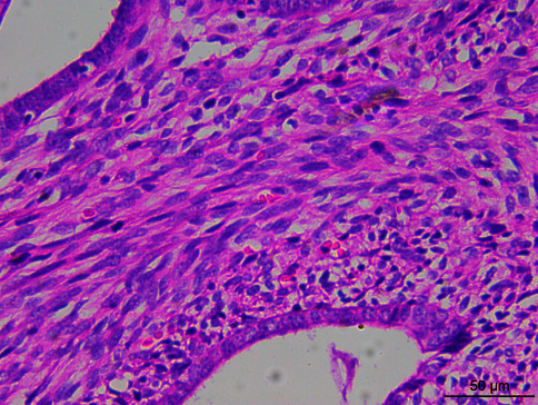 Next-Generation Sequencing Analysis of 3 Uterine Adenosarcomas with Heterogeneously Differentiated Genomic Mutations.